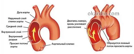 Аортна дисекация пълно описание, причини, видове, симптоми и лечение