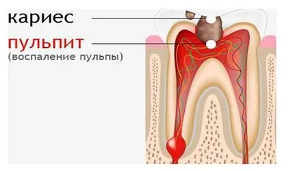 pulpa dintelui este ceea ce este, și video Tratamentul