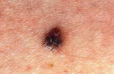 Рак на кожата - снимка, на първоначалния етап, симптоми и лечение