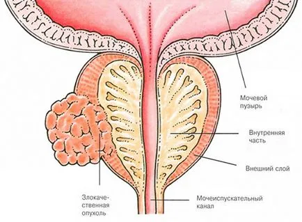 cancerul de prostată