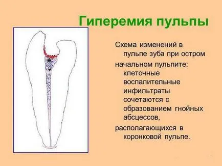 pulpa dintelui este ceea ce este, și video Tratamentul