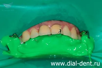 Ремонт на металокерамична корона на разцепване пред зъба
