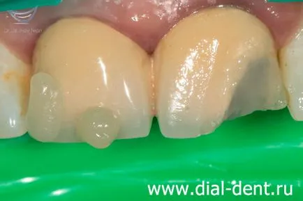 Ремонт на металокерамична корона на разцепване пред зъба