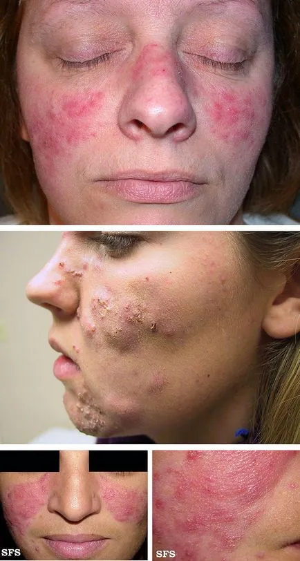 Rosacea (rosacea) - okok és a tünetek, kezelések