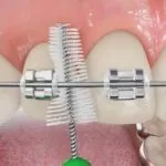 Perie pentru curățarea dinților și acolade, sfaturi ortodont