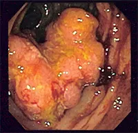 Metodele de tratament al cancerului intestinal in prezenta metastazelor la distanță, bloguri