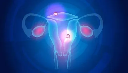 méh fibroid kezelés Multisite konzervatív és hagyományos módszereket