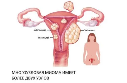 uterin tratament fibromului metode conservatoare și tradiționale multisite