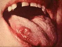 Сифилис лицево-челюстна шанкър, обрив по лицето