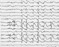 Ленъкс-Gastaut - причини, симптоми, диагностика и лечение