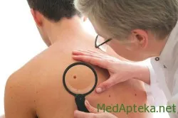 Tünetek első jelei melanoma, vélemények