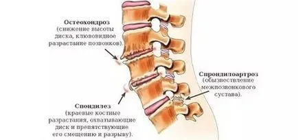 Спондилози на гръбначния стълб, което е то и как да се лекува