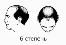 Alopecia besorolási szakaszban androgén (férfi) típusú alopecia