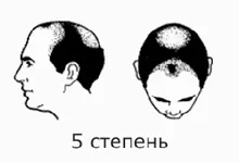 Alopecia besorolási szakaszban androgén (férfi) típusú alopecia