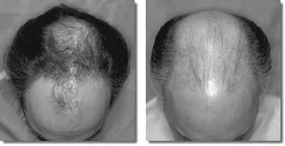 szakaszában alopecia