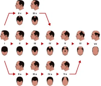 Stadiul de cheliei la bărbați, gradul de cadere a parului de Norwood, precum și caracteristicile distinctive