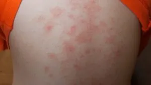 Streptoderma възрастни - какво е това, как да се лекува къща