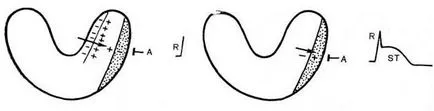 infarct miocardic subepicardial - tratament de inima