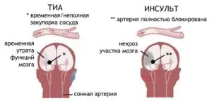 gemisindrom tranzitorii în accident vascular cerebral ischemic