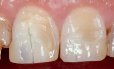 smalțul fisurată pe dintele frontal Ce cauzeaza fisuri, tratament