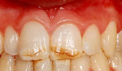 smalțul fisurată pe dintele frontal Ce cauzeaza fisuri, tratament