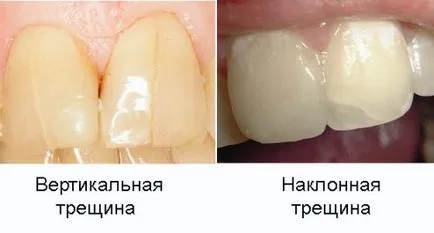 Напуканите емайл на предния зъб Какви са причините за пукнатини, лечение
