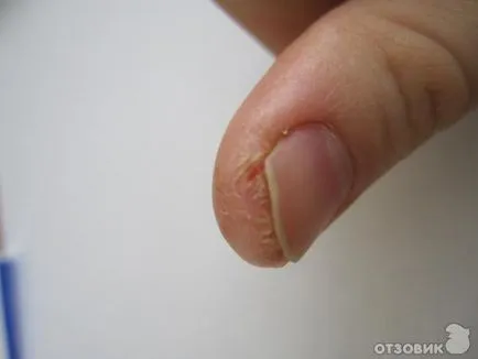 Fisurile din degetele in apropiere de unghii