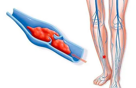 A vérrög a lábában tünetei tromboembólia és a kezelés