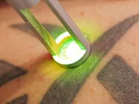 Îndepărtarea tatuajelor cu laser - proceduri, fotografii, recenzii și tarife
