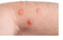 Akne (acne), ekcéma, pikkelysömör és a közös bőrproblémák