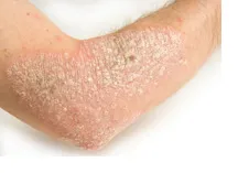 Akne (acne), ekcéma, pikkelysömör és a közös bőrproblémák