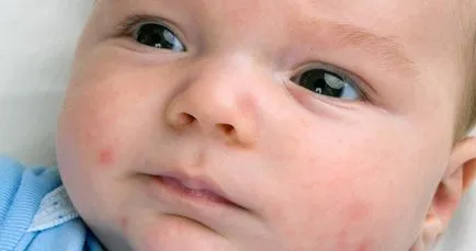 Новородено пъпки по лицето, отколкото лечение