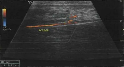 Блокада на сканиране от главните артерии на долните крайници