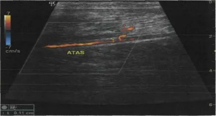 Ultrahang vizsgálat fő artériák az alsó végtagok