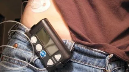 Устройства за прилагането на инсулин