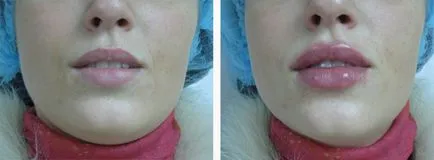 Növelje ajkak térfogatát botox