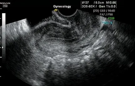 Узи в несъстоятелност на матката белег в края на следоперативния период - Chechneva м