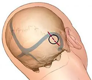 Ez tette az első high-tech műtét trigeminus neuralgia - Progresszív