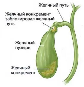 Gyulladás az epehólyag