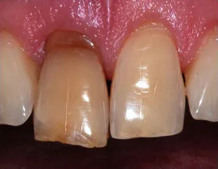 dinți intraluminale albire (endootbelivanie) dinți alb orbitor este real!