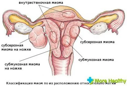 Какво противопоказания с миома трябва да се обърне специално внимание