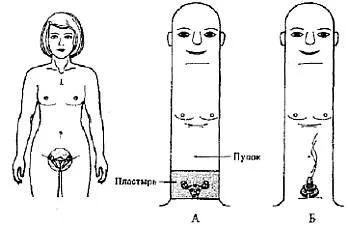 Parcela menstruatiei dureroase