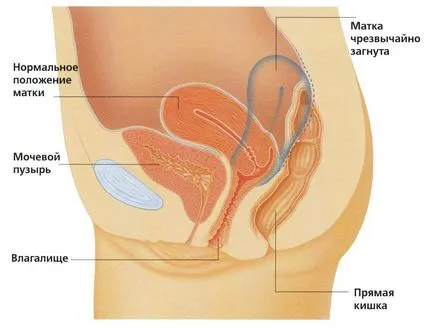 îndoire a caracteristicilor clinice ale uterului și tratamentul