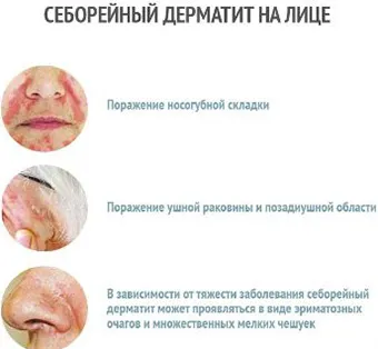 Olajos seborrhea a fejbőr és az arc, hogyan kell kezelni a betegséget samponnal, maszkok és egyéb eszközök