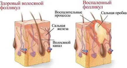 Olajos seborrhea a fejbőr és az arc, hogyan kell kezelni a betegséget samponnal, maszkok és egyéb eszközök