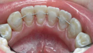 Зъби след скоби са се разделили