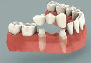 instalare punte dentara, care este mai bine de a alege