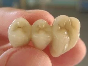 instalare punte dentara, care este mai bine de a alege