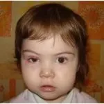 Allergy на клепачите и лечение на очите причинява, мазила, капки, подуване, подуване, червено