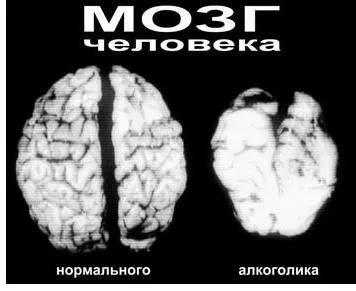 Алкохолът и съдове на мозъка въздействието на алкохола върху мозъка